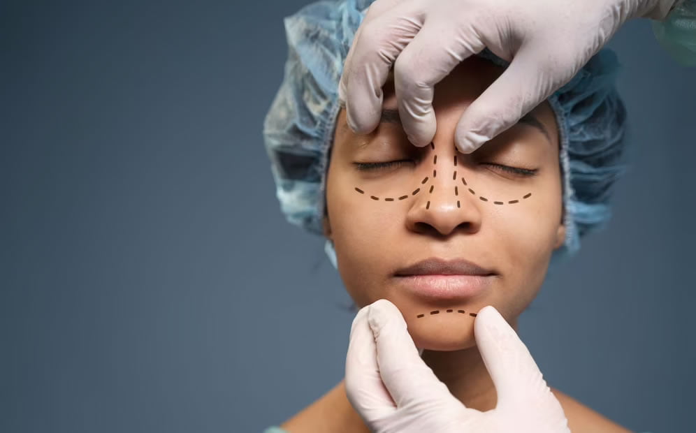 Rinoplastia: Tudo que você precisa saber antes de tomar sua decisão 3 Rinoplastia