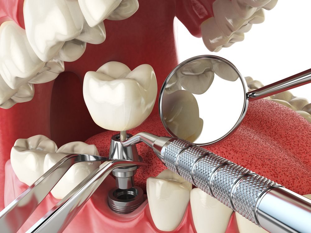 Implantes Dentários: A Revolução que Mudou para Sempre a Reabilitação Oral 6 Implantes Dentários: A Revolução que Mudou para Sempre a Reabilitação Oral 5